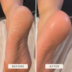 SOLEA™ Silk Pro